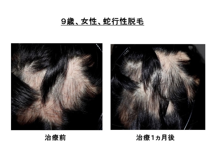 円形脱毛症　病院